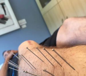 Dry needling for muscle pain can help relieve trigger points, reduce tension, and improve movement. Learn about its benefits, procedure, risks, and results.